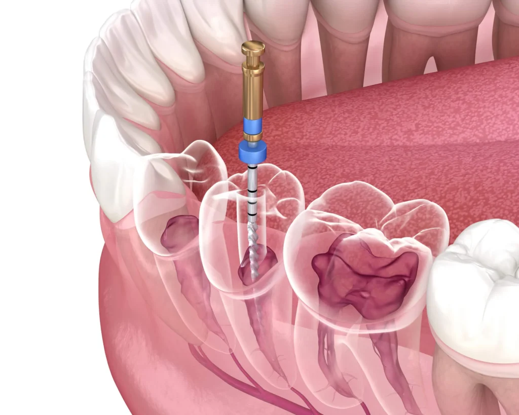 3D illustration of root canal st petersburg