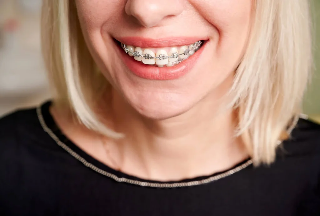 Invisalign and braces Da Vista St. Pete