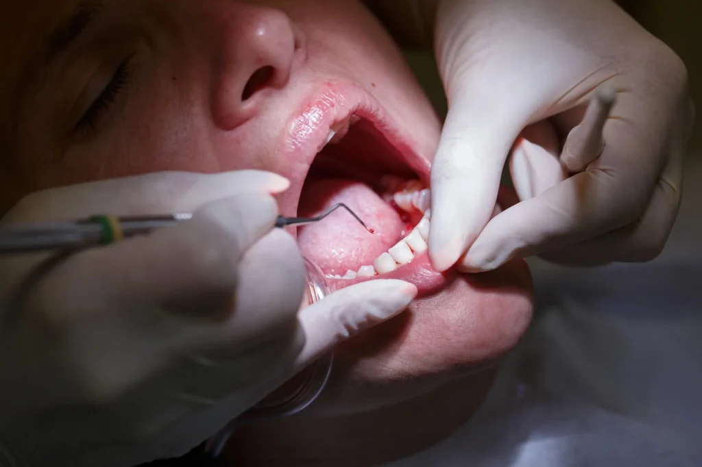 ongoing Gum disease treatment in Imperial Courts Clearwater