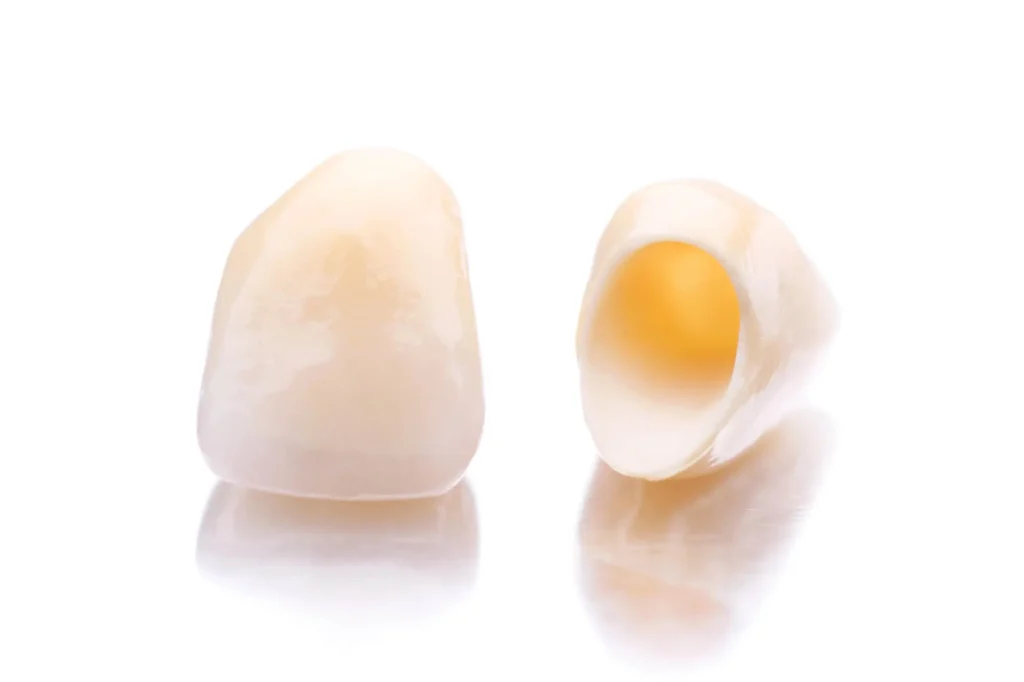 traditional vs Same-day crowns in Pasadena, St. Petersburg