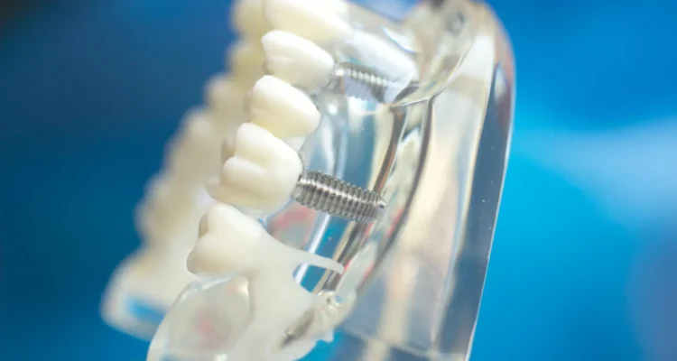 Dental implants Pasadena St. Petersburg FL