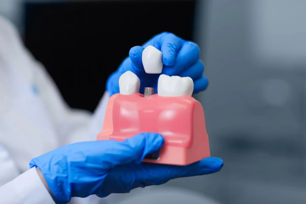 model for Dental implants Pasadena St. Petersburg FL