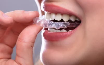 close up of mouth with Clear aligners provider near MorningsideMeadows