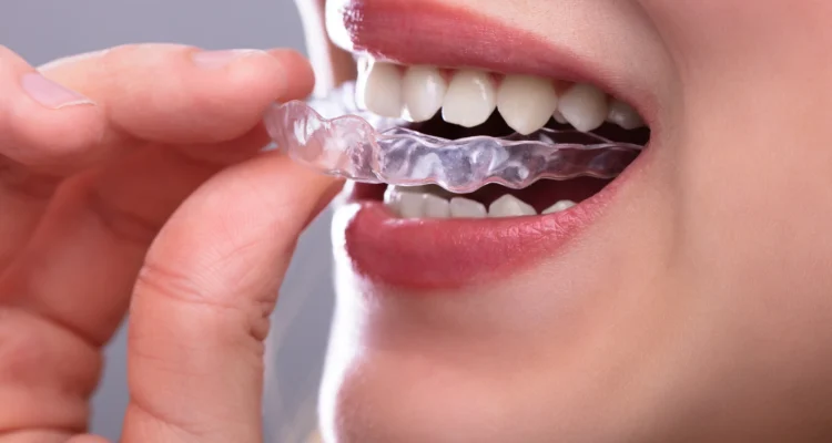 close up of mouth with Clear aligners provider near MorningsideMeadows