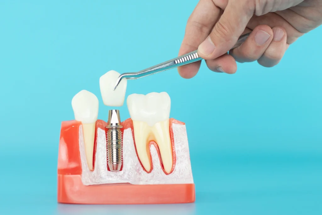 dentist in Clearwater with implant model